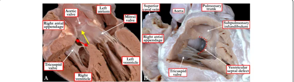 Figure 1 The images show the problems existing in defining the boundaries of the area of space that represents themuscular septum