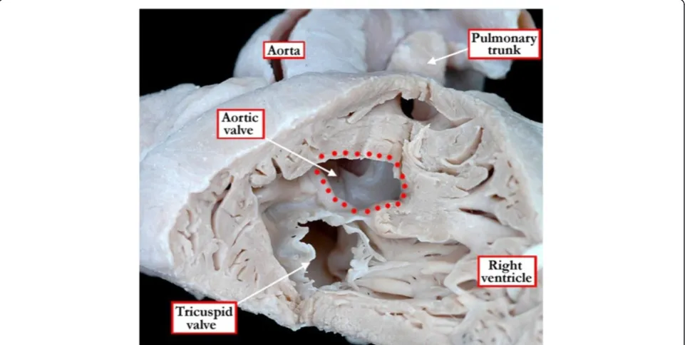 Figure 3 In this heart, the right ventricle has been windowed, and the structures are viewed from the ventricular apex