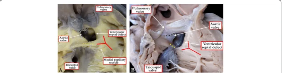 Figure 6 In this heart (A) with a doubly committed and juxta-arterial ventricular septal defect there is fibrous continuity between theleaflets of the arterial valves (black dots) at the roof of the defect, with a muscular bar (yellow dots) separating the 