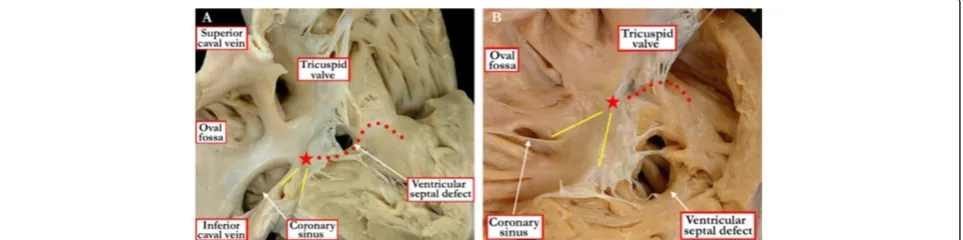 Figure 7 The view from the left ventricle in this specimen showsa ventricular septal defect with exclusively muscular bordersopening towards the outlet of the right ventricle, but withpostero-caudal deviation of the muscular outlet septum(yellow dots), causing subaortic stenosis.