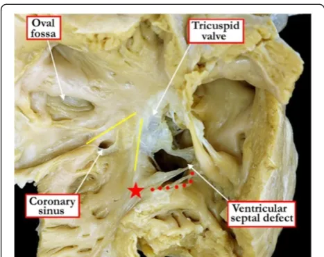 Figure 9 The rule regarding the location of the conduction axis(red dots) in hearts with perimembranous ventricular septaldefects holds good for all instances except when there ismalalignment between the atrial septum and the apicalmuscular septum