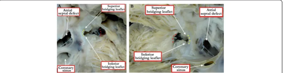 Figure 10 Defects can also open to the inlet of the right ventricle when they are part of an atrioventricular septal defect with acommon atrioventricular valve