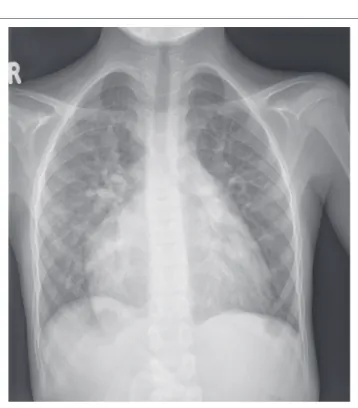 FIGURE 2: Frontal chest radiograph demonstrating dextrocardia with right-sided  aortic arch and right-sided stomach bubble in right isomerism.