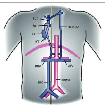 FIGURE  10:  Illustration  showing  the  position  of  the  aorta  and  IVC  in  right  isomerism