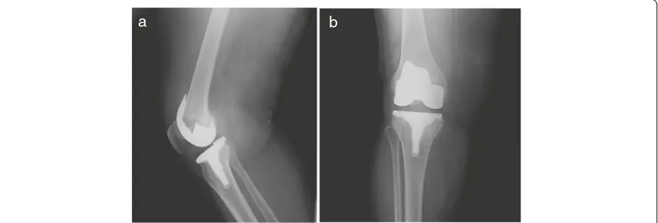 Fig. 1 Preoperative x-ray images of the a) lateral and b) AnteroPosterior (AP) view of the right knee showing prosthesis without loosening