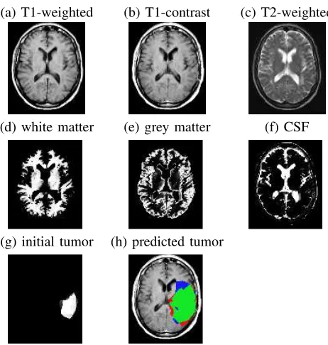 Figure 1.(b) T1-weighted scan after injecting the patient with gladolinium con-