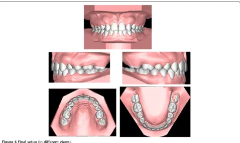 Figure 5 Occlusal interferences. The selected teeth are represented in grey.