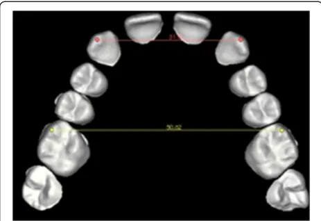 Figure 7 Measurement of the inter-canine and inter-molardiameters after setup.