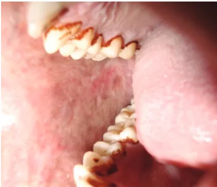 Fig. 1 Blanching of the buccal mucosa with erythematous areas (black arrow).