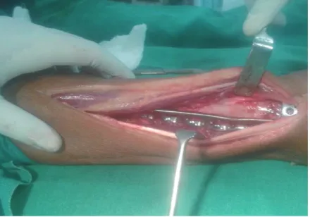 Fig. 2 Open reduction and internal fixation with medial LCP. 