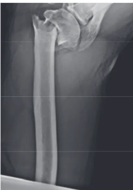 Fig. 1 X-ray shoulder joint, A-P view.