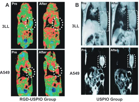 Figure 5 Pseudo-color magnetic resonance (MR) images of tumors after the of UsPIO injection of RgD-UsPIO A) and T2-weighted MR images of tumor after the injection B) Pseudo color MR images reflected the reduction of signal intensity in 3LL tumor mainly dis