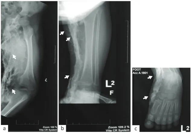 Figure 1. Clinical features of left leg at the first examination. (a) Left inguinal lump (white arrow); (b) multiple small lumps, located in the medial left thigh, medial left leg, and left foot