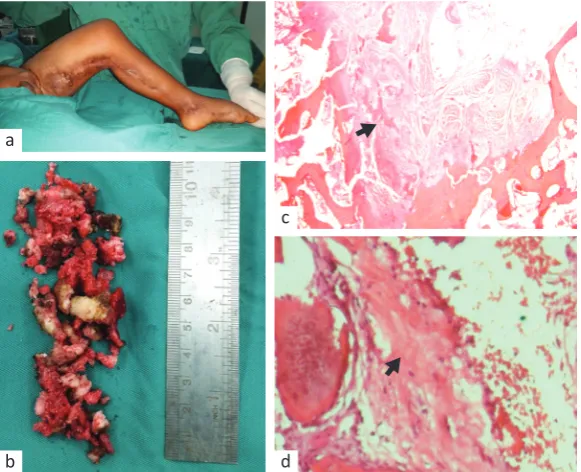 Figure 3. Sagittal reformat from computed tomography scan of the left leg showing soft tissue mass with calcification (white arrow) from the left thigh until the leg and infiltration to the left obturator muscle, adductor longus muscle, gluteus maximus mus
