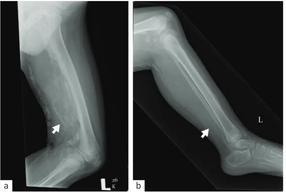 Figure 5. Follow-up imaging after the third resection showed a significant reduction in ossification in the: (a) inner left thigh (white arrow) and (b) leg (white arrow)