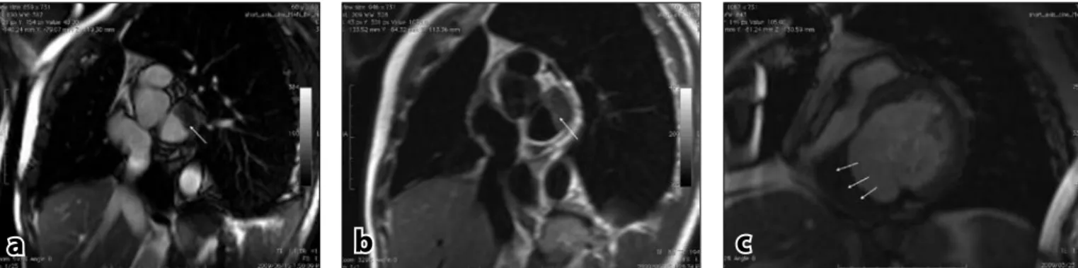 Fig. 2a. Bright-blood image showing thrombus (arrow) in a typical site with the left atrium