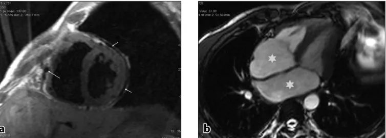 Fig. 4. Gradient echo bright blood image in the plane of the left ventricular  outflow showing prominent low signal (spin dephasing) owing to turbulent  flow from aortic regurgitation (arrow), leading to early closure of the mitral  valve anterior leaflet.