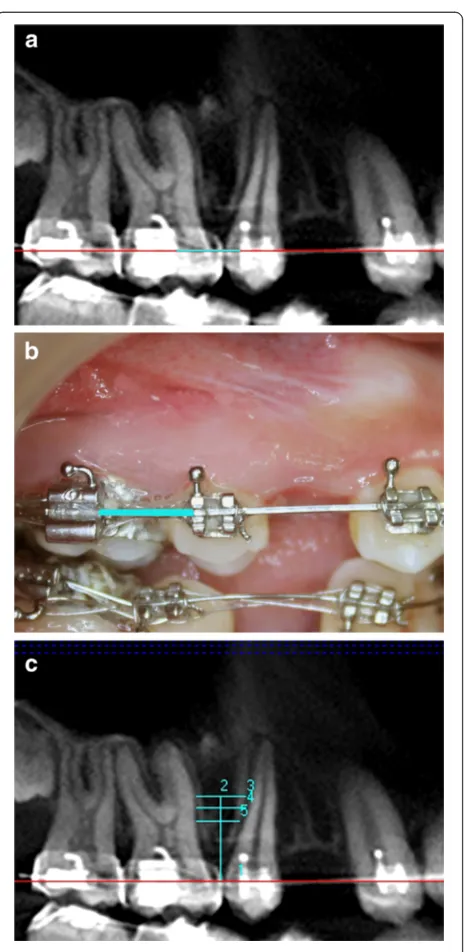 Figure 1 Orthodontic arch wire in second premolar and firstmolar region taken as standard reference for measurements.(a) Panorex View of CBCT image, (b) correlated clinically, and(c) various heights from the arch wire within the limits of mucogingivaljunction selected for bone measurements.