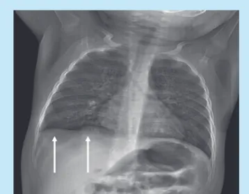 Fig. 2. Image showing the chevron artefact consisting of alternating dark  and light bands, indicated by the white arrows.