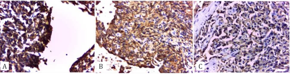 Figure 2. Immunohistochemical staining of p53 in HCC under light microscopy with objective lens magnification of 100 times