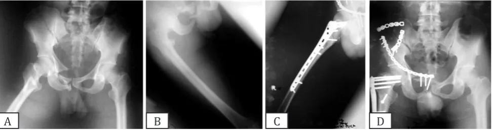Figure 1. (A,B) Case 1. Roentgen of proximal femur presented subtrochanter fractures with floating hip; (C,D) Follow-up of 28 weeks