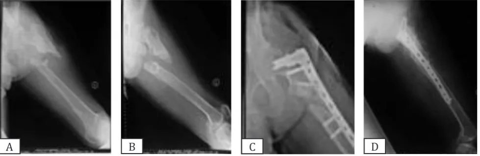 Figure 5. (A,B) Case 3. X-rays of the neglected proximal femur fracture subtrochanter; (C,D) X-rays of post-operative 