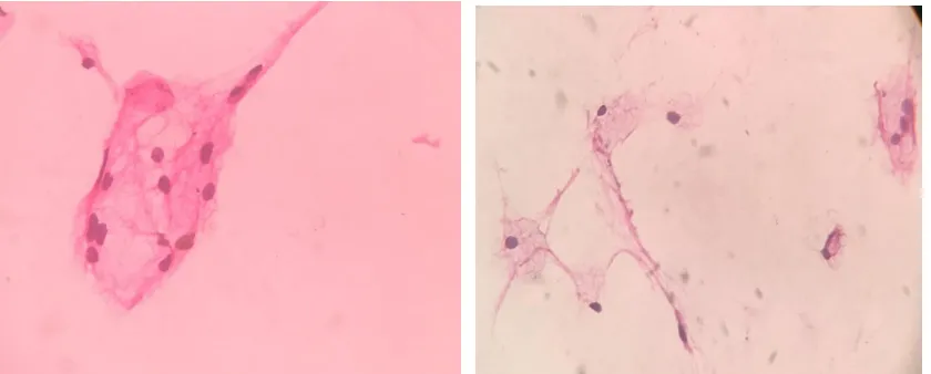 Fig 6: FNAC Suggestive of Galactocele, 40x: Smear shows cyst macrophages, inflammatory cells and occasional      duct epithelial cells in a proteinaceous background
