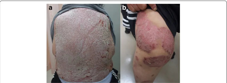 Fig. 1 Photographs of the patient’s back (a) and right knee (b) 1 year prior to admission, showing poorly controlled psoriasis vulgaris