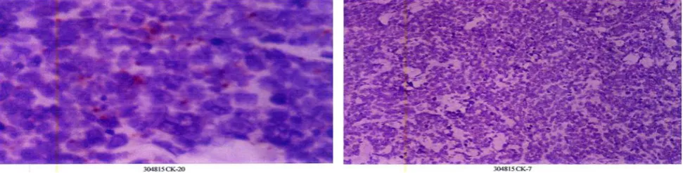 Figure 3. Immunohistochemical staining showing CK20 positive and CK7 negative 