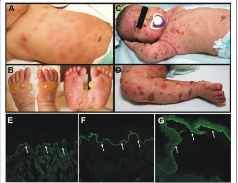 Figure 1 Clinical and diagnostic hallmarks of infantile BP.and bullae on the hands and feet.microscopy:immunofluorescence on salt-split skin reveals circulating IgG antibodies that bind to the blister roof, which is diagnostic for BP (white arrows, 200× Pa