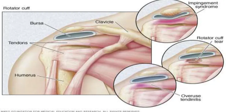 Figure 2: In frozen shoulder, the smooth tissues of the shoulder capsule become thick, stiff, and inflamed
