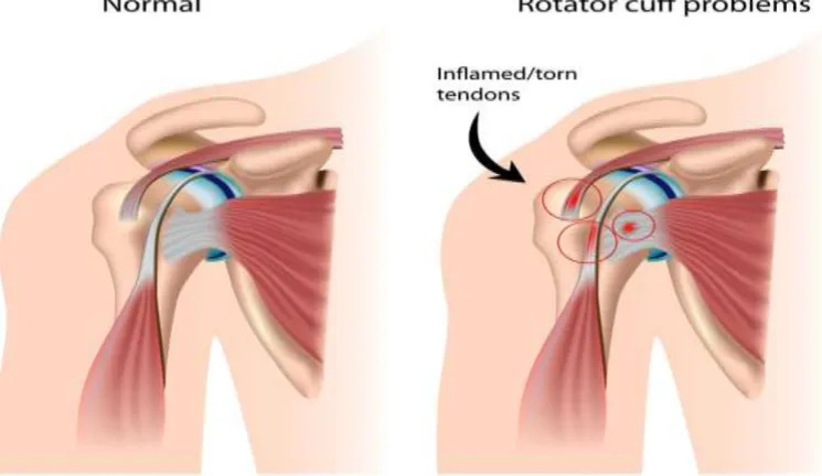 Figure 5: Difference between normal Tendons and Inflamed Tendons. 