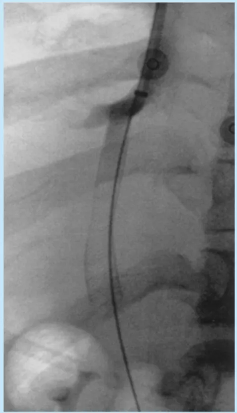 Fig. 1c.  A final check portogram shows flow of contrast through the shunt into the hepatic vein thereby decompressing the portal system