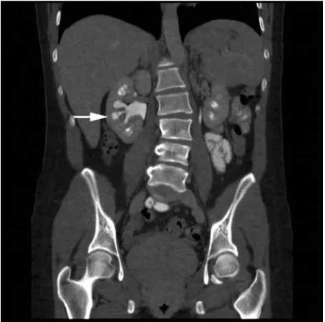 Figure 2 Computerized tomography urogram (post-contrast) coronal view demon-strating dilated medullary contrast-ﬁlled tubules and medullary calciﬁcations (arrow).Note: Reprinted from Perm J