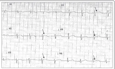 Fig. 1 Electrocardiogram from patient with ST-segment elevations (arrows) in V2-V4 precordial leads