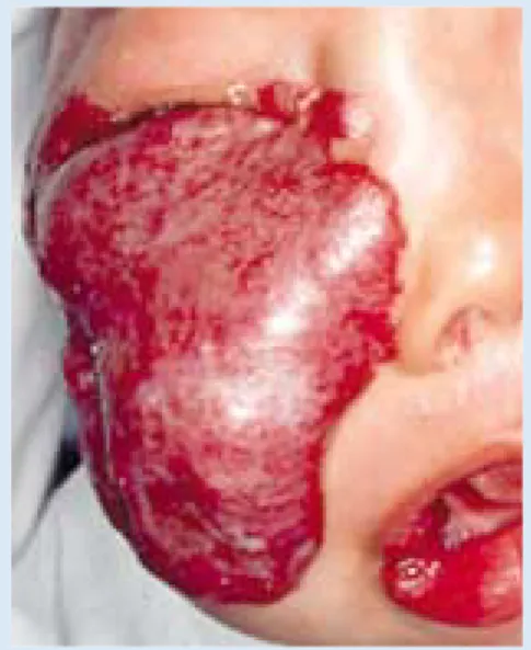 Fig. 1b. Large maxillary and periorbital cutaneous haemangioma.  Its  anatomical  position  threatens the function of the eye.