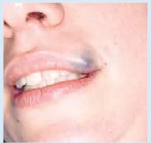 Fig.  3a.  Small  venous  malformation  of  an  upper lip. Note the characteristic bluish colouration.