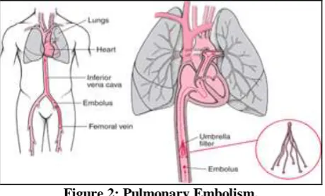 Figure 2: Pulmonary Embolism.  