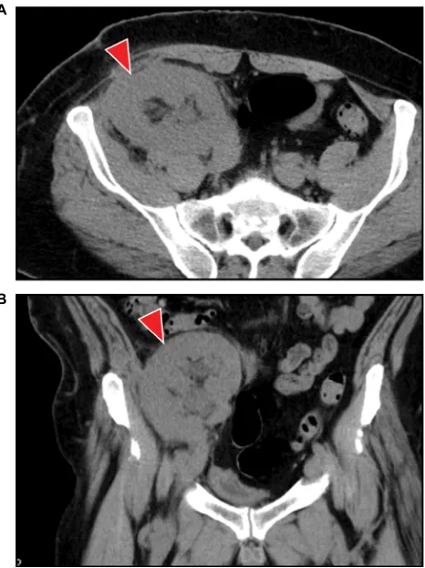 Figure 3 Representative allograft images of Ct after surgical exploration.Notes: Ct revealed a loss of the hematoma with air in the upper urinary tract of the allograft