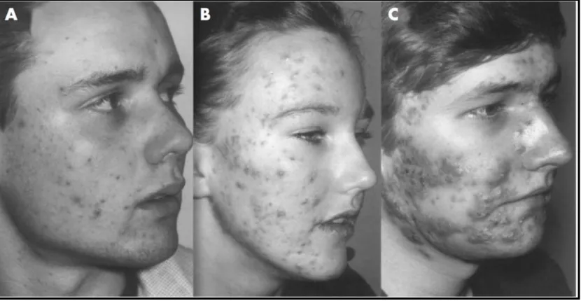 Figure 2.2 Photographs illustrating different grades of acnes (A) Mild acne (grade 2): Numerous comedones and small inflammatory papules, numerous pustules; (C) Server acne (grade 12): numerous Comedones, deeper papules and pustules, deep and large lesions, presence of cysts and abscesses (Ayer and Burrows, 2009)   Comedones: a few small papules and a few pustules; (B) Moderate acne (grade 7):  