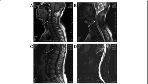Fig. 1 MRI image of the patient with multifocal musculoskeletal tuberculosis.thoracic vertebra