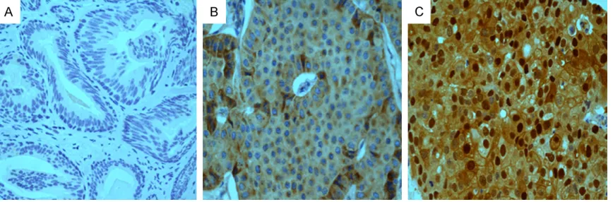 Figure 1. Expression of CSE1L protein in tissue by immunohistochemistry. A. Cytoplasmic and nuclear low expres-sion of CSE1L in benign breast specimen