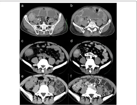Fig. 2 Different enhancement patterns of the solid masses. a,b: intestinal tuberculosis (ITB) in a old man with a history of left lower quadrant(LLQ) pain and abdominal distension for 20 days