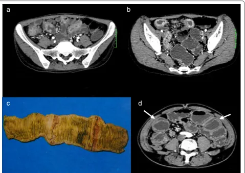 Fig. 3 Symmetric intestinal mural thickening and double ring sign. Intestinal tuberculosis (ITB) in a old man with a history of left lower quadrant (LLQ) painas circumferential ulcer in the gross specimen.asmural thickening with irregular ill-defined margi