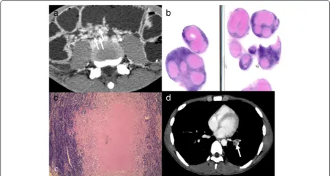 Fig. 4 Peripheral rim enhancement of lymph nodes. Intestinal tuberculosis (ITB) in a young man had a history of right lower quandrant (RLQ) pain forthree months