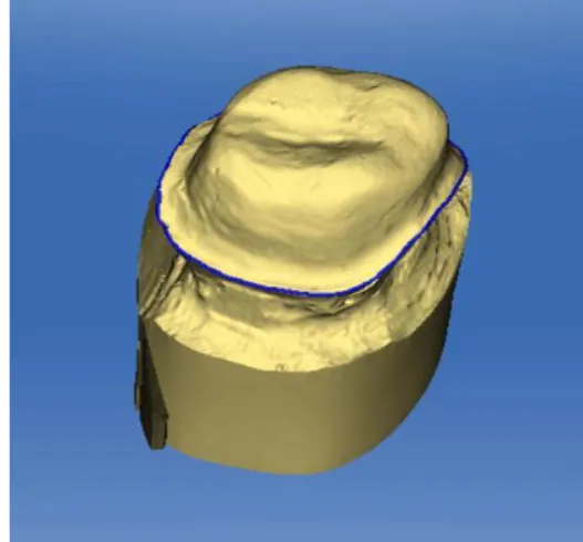 Figure 3. The designed crown using the CEREC system 