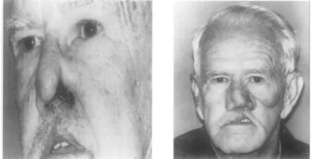 Figure 1: Lateral nasal defect and anatomically nasal Prosthesis.[3]  