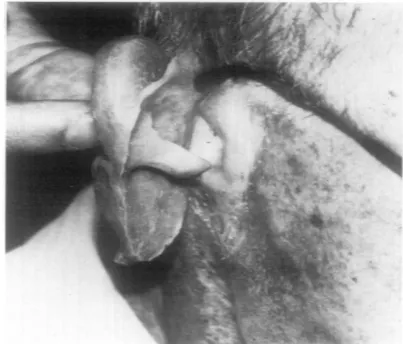 Figure 2: Lateral nasal-canthal prosthesis with projections and prosthesis in situ.[3]  