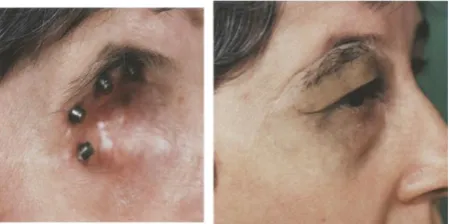 Figure 7: Retentive bar and ear prosthesis in situ.[12] 