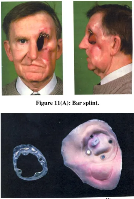 Figure 11(A): Bar splint. 